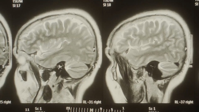Video Reference N1: Medical imaging, Computed tomography, Brain, Radiography, Head, Brain, Organ, Medical radiography, Radiology, Human body